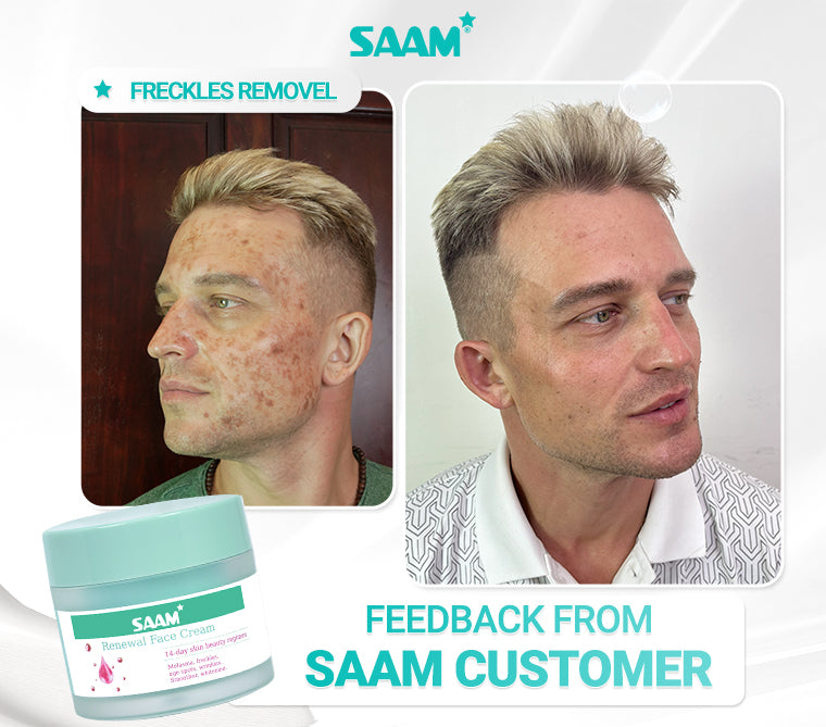 Saam 50g Renewal Face Cream For Melasma And Freckles Treatment 50g