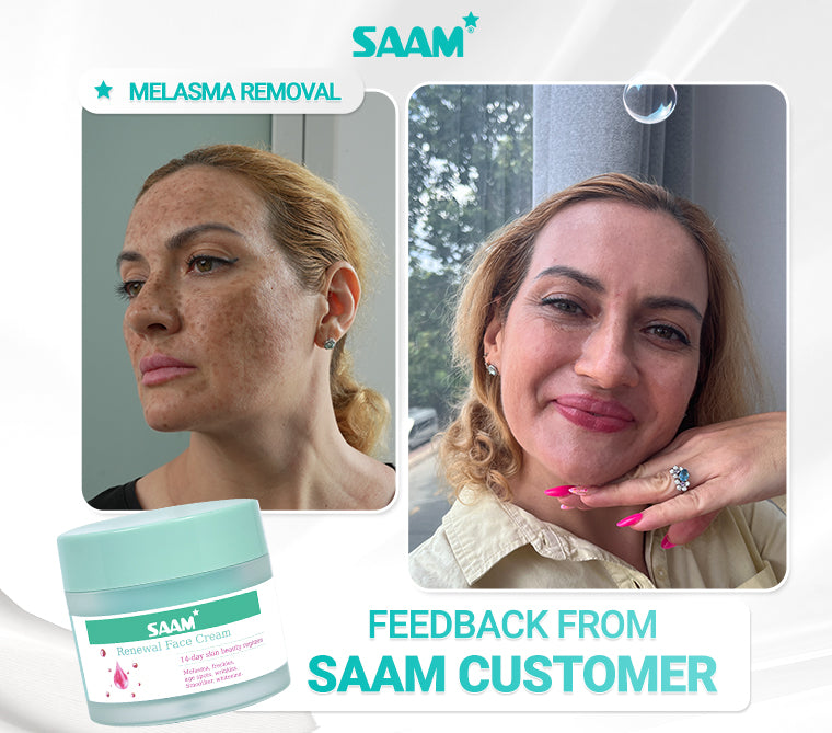 Saam 50g Renewal Face Cream For Melasma And Freckles Treatment 50g