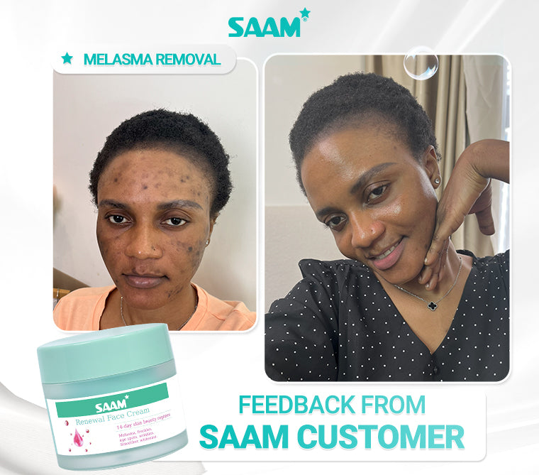 Saam 50g Renewal Face Cream For Melasma And Freckles Treatment 50g