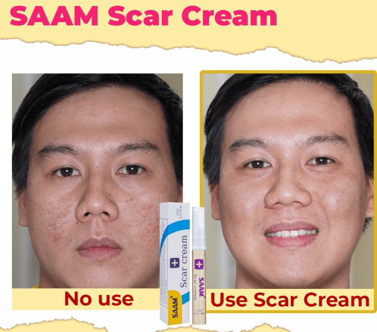 SAAM Scar Cream Fade Minor Scars & Achieve Even Skin Tone 15g